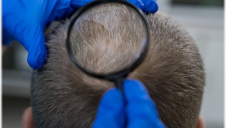 Επανάσταση κατά της τριχόπτωσης με επίκεντρο τη... στέβια!