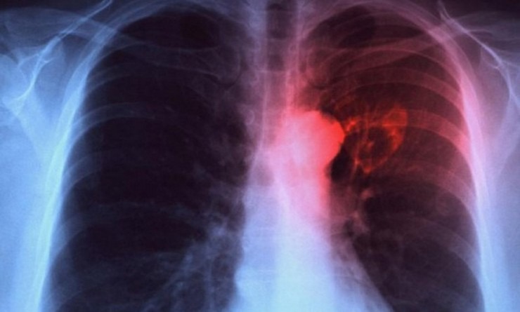 Η φυματίωση μας απειλεί ακόμα... | Sofokleousin.gr