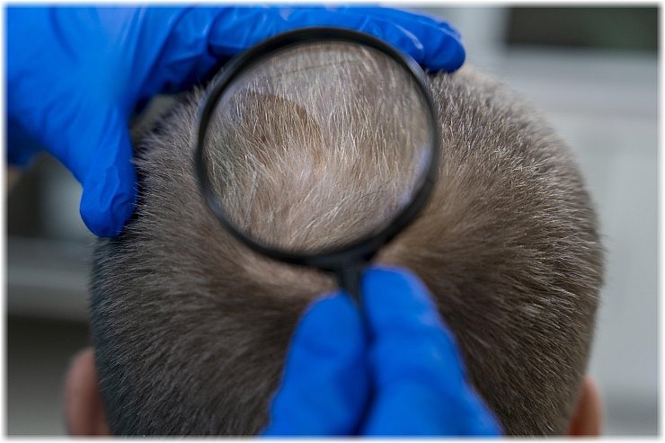 Επανάσταση κατά της τριχόπτωσης με επίκεντρο τη... στέβια!