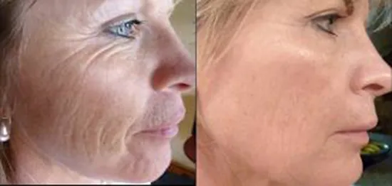 Skin Needling: Τι είναι και πως ανανεώνει το πρόσωπο μας