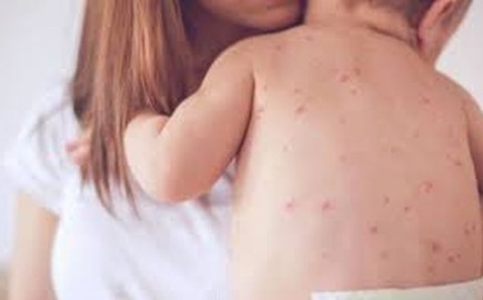 ΕΟΔΥ: Η ιλαρά συνεχίζει να προκαλεί σοβαρές επιπλοκές και θανάτους